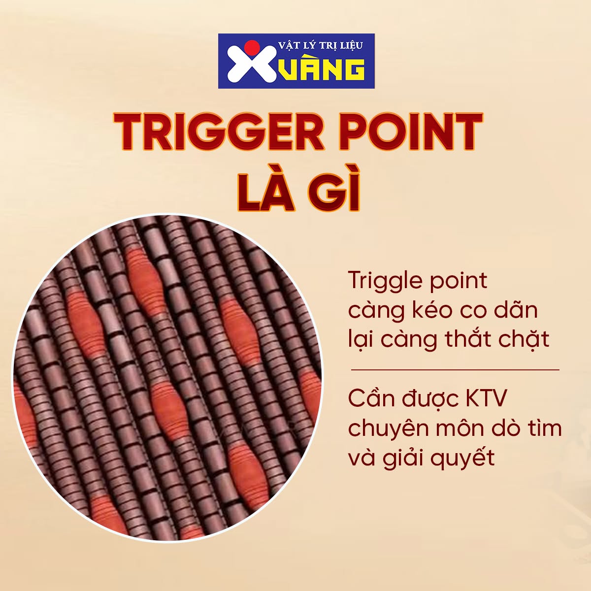 Thông tin về điểm đau trigger point